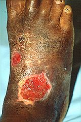 Snake bite of an unidentified pit viper (Crotalinae).