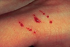 Bite of an aplypha snake.
